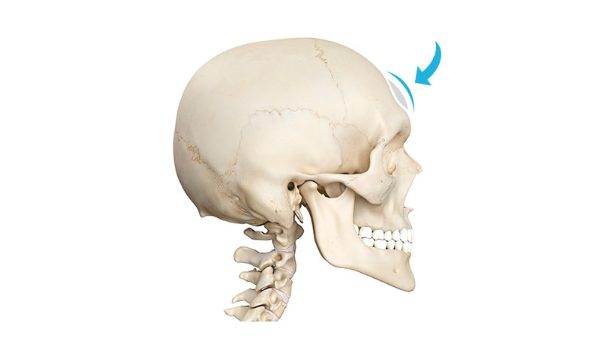 Implant Forehead Surgery